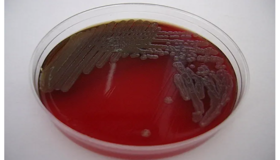 嗜麦芽窄食单胞菌的诊断标准与试验结果！