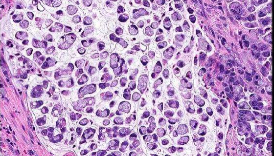 人胃腺癌细胞的培养步骤与应用！