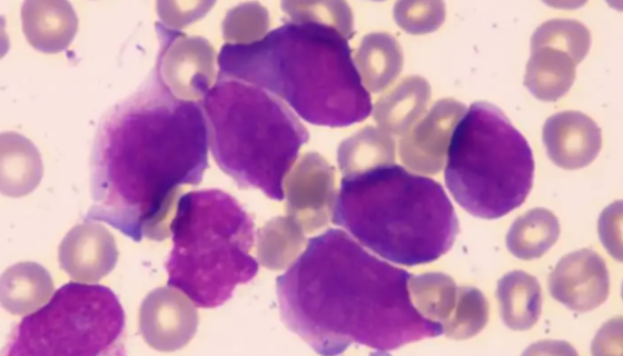 人急性髓系白血病细胞接收后的操作流程与注意事项！