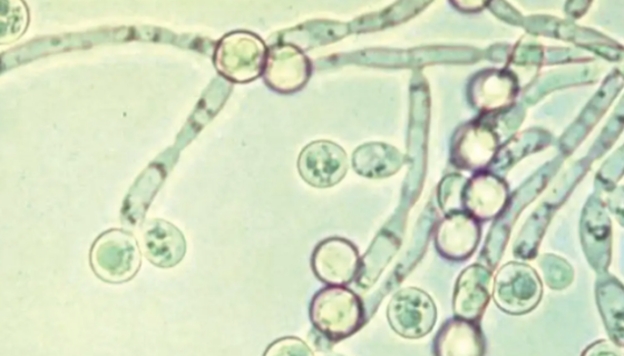 白色念珠菌病的临床症状及预防与治疗！