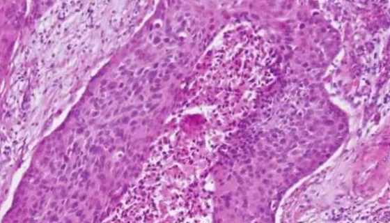 Tca-83人口腔鳞癌细胞的培养方法与注意事项！
