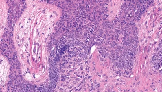 人喉表皮癌细胞复苏与冻存的处理方法有哪些？