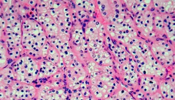 人肾癌细胞的处理方法与培养步骤及注意事项！