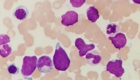 人弥漫大B淋巴瘤细胞验收时的注意事项有哪些？