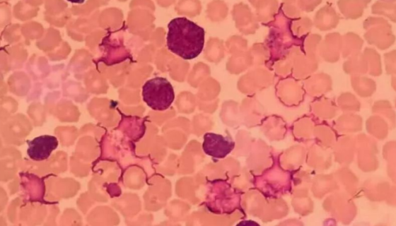 DoHH2人胸腔积液滤泡中心母细胞的培养方法！