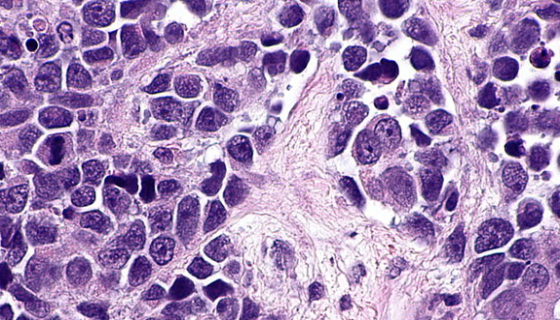 RT-112人膀胱癌细胞的处理方法与培养步骤！