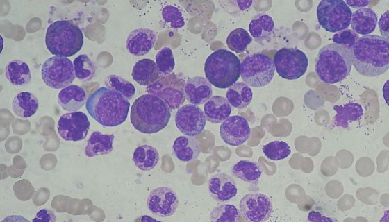 人慢性髓白血病细胞的处理方法与培养步骤！