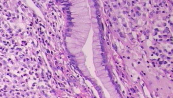 人胃肠道间质瘤细胞的临床表现及相关研究！