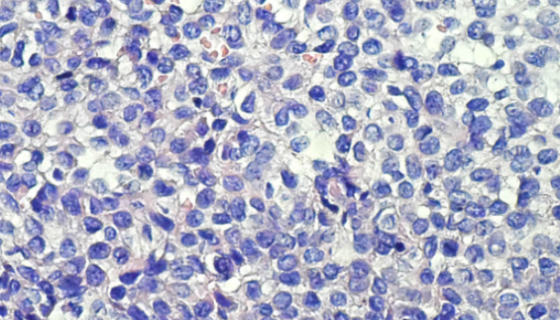 人成釉細(xì)胞瘤細(xì)胞的臨床表現(xiàn)及診斷與治療！