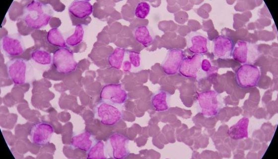 人T淋巴瘤細(xì)胞系的復(fù)蘇與傳代及凍存與應(yīng)用！