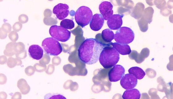 急性髓系细胞白血病细胞的培养操作规程及应用！