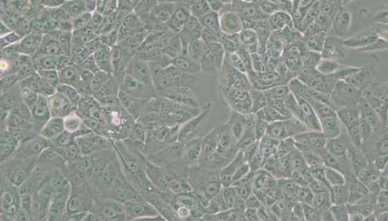 膀胱移行細(xì)胞癌的臨床表現(xiàn)與檢查方法及診斷與治療！