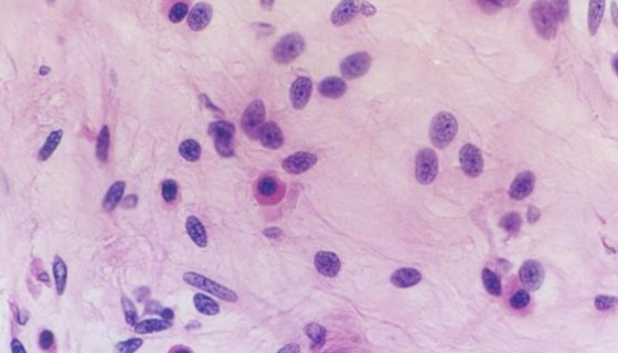 人甲狀腺乳頭狀癌細(xì)胞復(fù)蘇與傳代及凍存操作說明！